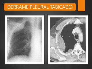 DERRAME PLEURAL TABICADO
 