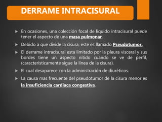  En ocasiones, una colección focal de liquido intracisural puede
tener el aspecto de una masa pulmonar.
 Debido a que divide la cisura, este es llamado Pseudotumor.
 El derrame intracisural esta limitado por la pleura visceral y sus
bordes tiene un aspecto nítido cuando se ve de perfil,
(característicamente sigue la línea de la cisura).
 El cual desaparece con la administración de diuréticos.
 La causa mas frecuente del pseudotumor de la cisura menor es
la insuficiencia cardiaca congestiva.
DERRAME INTRACISURAL
 