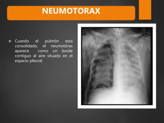 Cuando el pulmón esta
consolidado, el neumotórax
aparece como un borde
contiguo al aire situado en el
espacio pleural.
NEUMOTORAX
 