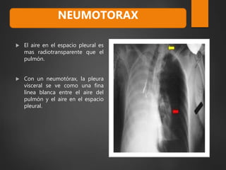  El aire en el espacio pleural es
mas radiotransparente que el
pulmón.
 Con un neumotórax, la pleura
visceral se ve como una fina
línea blanca entre el aire del
pulmón y el aire en el espacio
pleural.
NEUMOTORAX
 