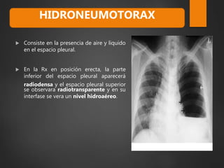  Consiste en la presencia de aire y liquido
en el espacio pleural.
 En la Rx en posición erecta, la parte
inferior del espacio pleural aparecerá
radiodensa y el espacio pleural superior
se observara radiotransparente y en su
interfase se vera un nivel hidroaéreo.
HIDRONEUMOTORAX
 