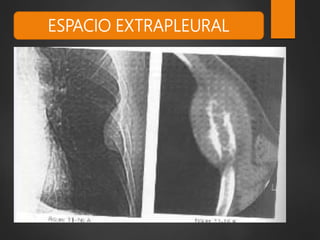ESPACIO EXTRAPLEURAL
 
