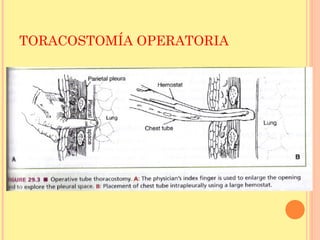 TORACOSTOMÍA OPERATORIA
 