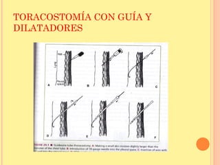 TORACOSTOMÍA CON GUÍA Y
DILATADORES
 