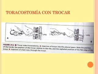 TORACOSTOMÍA CON TROCAR
 