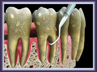 11.scaling and root planing | PPTX