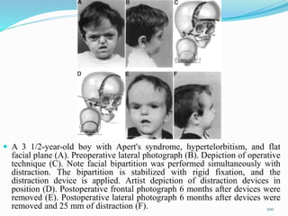  A 3 1/2-year-old boy with Apert's syndrome, hypertelorbitism, and flat
facial plane (A). Preoperative lateral photograph (B). Depiction of operative
technique (C). Note facial bipartition was performed simultaneously with
distraction. The bipartition is stabilized with rigid fixation, and the
distraction device is applied. Artist depiction of distraction devices in
position (D). Postoperative frontal photograph 6 months after devices were
removed (E). Postoperative lateral photograph 6 months after devices were
removed and 25 mm of distraction (F). 100
 