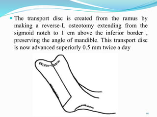  The transport disc is created from the ramus by
making a reverse-L osteotomy extending from the
sigmoid notch to 1 cm above the inferior border ,
preserving the angle of mandible. This transport disc
is now advanced superiorly 0.5 mm twice a day
110
 