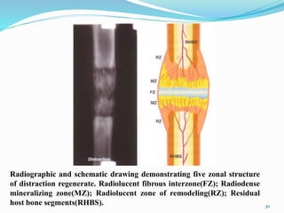 Radiographic and schematic drawing demonstrating five zonal structure
of distraction regenerate. Radiolucent fibrous interzone(FZ); Radiodense
mineralizing zone(MZ); Radiolucent zone of remodeling(RZ); Residual
host bone segments(RHBS). 30
 