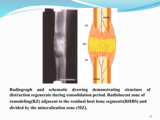 Radiograph and schematic drawing demonstrating structure of
distraction regenerate during consolidation period. Radiolucent zone of
remodeling(RZ) adjacent to the residual host bone segments(RHBS) and
divided by the mineralization zone (MZ).
32
 