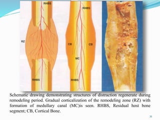 Schematic drawing demonstrating structures of distraction regenerate during
remodeling period. Gradual corticalization of the remodeling zone (RZ) with
formation of medullary canal (MC)is seen. RHBS, Residual host bone
segment; CB, Cortical Bone.
35
 