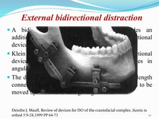 External bidirectional distraction
 A bidirectional distraction appliance provides an
additional degree of freedom over the unidirectional
device.
 Klein & Howaldt developed an external bi-directional
device capable of achieving controlled changes in
angulation.
 The device consists of two geared arms 5 cm in length
connected to a middle screw that enables the arms to be
moved up or down to change angulations.
42
Deirdre J. Maull, Review of devices for DO of the craniofacial complex ,Semin in
orthod 5:9-24,1999 PP 64-73
 