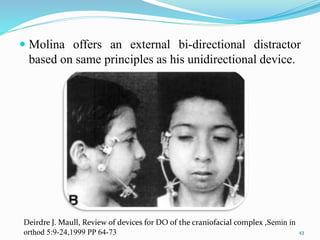  Molina offers an external bi-directional distractor
based on same principles as his unidirectional device.
43
Deirdre J. Maull, Review of devices for DO of the craniofacial complex ,Semin in
orthod 5:9-24,1999 PP 64-73
 