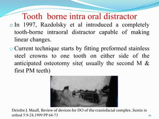 Tooth borne intra oral distractor
o In 1997, Razdolsky et al introduced a completely
tooth-borne intraoral distractor capable of making
linear changes.
o Current technique starts by fitting preformed stainless
steel crowns to one tooth on either side of the
anticipated osteotomy site( usually the second M &
first PM teeth)
49
Deirdre J. Maull, Review of devices for DO of the craniofacial complex ,Semin in
orthod 5:9-24,1999 PP 64-73
 