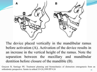 The device placed vertically in the mandibular ramus
before activation (A). Activation of the device results in
an increase in the vertical height of the ramus. Note the
separation between the maxillary and mandibular
dentition before closure of the mandible (B).
55
Grayson B, Santiago PE: Treatment planning and biomechanics of distraction osteogenesis from an
orthodontic perspective. Semin in orthod 5:9-24,1999 PP 9-24
 