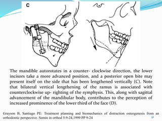The mandible autorotates in a counter- clockwise direction, the lower
incisors take a more advanced position, and a posterior open bite may
present itself on the side that has been lengthened vertically (C). Note
that bilateral vertical lengthening of the ramus is associated with
counterclockwise up- righting of the symphysis. This, along with sagittal
advancement of the mandibular body, contributes to the perception of
increased prominence of the lower third of the face (D).
56
Grayson B, Santiago PE: Treatment planning and biomechanics of distraction osteogenesis from an
orthodontic perspective. Semin in orthod 5:9-24,1999 PP 9-24
 