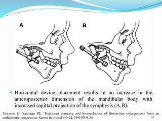  Horizontal device placement results in an increase in the
anteroposterior dimension of the mandibular body with
increased sagittal projection of the symphysis (A,B).
58
Grayson B, Santiago PE: Treatment planning and biomechanics of distraction osteogenesis from an
orthodontic perspective. Semin in orthod 5:9-24,1999 PP 9-24
 