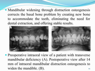  Mandibular widening through distraction osteogenesis
corrects the basal bone problem by creating new bone
to accommodate the teeth, eliminating the need for
dental extraction, and offering stable results.
 Preoperative intraoral view of a patient with transverse
mandibular deficiency (A). Postoperative view after 14
mm of intraoral mandibular distraction osteogenesis to
widen the mandible. (B). 80
 
