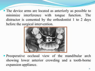  The device arms are located as anteriorly as possible to
minimize interference with tongue function. The
distractor is cemented by the orthodontist 1 to 2 days
before the surgical intervention.
 Preoperative occlusal view of the mandibular arch
showing lower anterior crowding and a tooth-borne
expansion appliance.
81
 