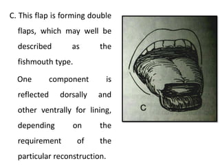 C. This flap is forming double
flaps, which may well be
described as the
fishmouth type.
One component is
reflected dorsally and
other ventrally for lining,
depending on the
requirement of the
particular reconstruction.
 