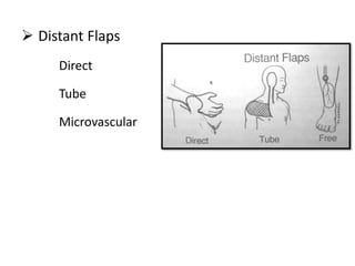  Distant Flaps
Direct
Tube
Microvascular
 