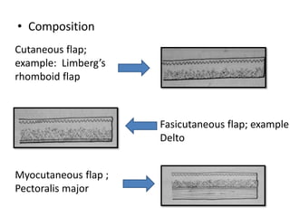• Composition
Cutaneous flap;
example: Limberg’s
rhomboid flap
Fasicutaneous flap; example
Delto
Myocutaneous flap ;
Pectoralis major
 