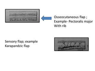 Sensory flap; example
Karapandzic flap
Osseocutaneous flap ;
Example- Pectoralis major
With rib
 
