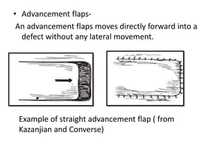 • Advancement flaps-
An advancement flaps moves directly forward into a
defect without any lateral movement.
Example of straight advancement flap ( from
Kazanjian and Converse)
 