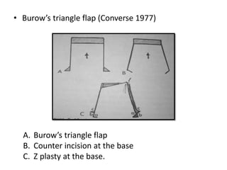 • Burow’s triangle flap (Converse 1977)
A. Burow’s triangle flap
B. Counter incision at the base
C. Z plasty at the base.
 
