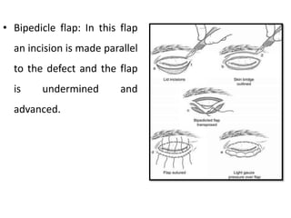 • Bipedicle flap: In this flap
an incision is made parallel
to the defect and the flap
is undermined and
advanced.
 