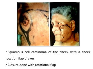 • Squamous cell carcinoma of the cheek with a cheek
rotation flap drawn
• Closure done with rotational flap
 