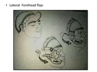 • Lateral Forehead flap-
 