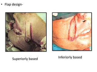 • Flap design-
Superiorly based Inferiorly based
 