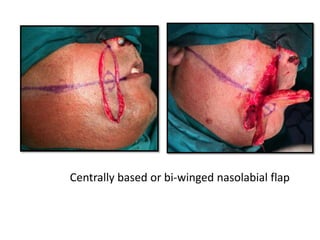 Centrally based or bi-winged nasolabial flap
 