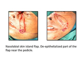 Nasolabial skin island flap. De-epithelialized part of the
flap near the pedicle.
 