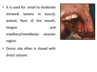 • It is used for small to moderate
intraoral lesions in buccal,
palatal, floor of the mouth,
tongue and
maxillary/mandibular alveolar
region.
• Donor site often is closed with
direct closure.
 