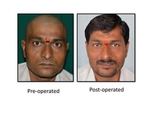 Pre-operated Post-operated
 