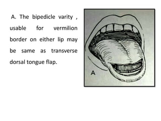 A. The bipedicle varity ,
usable for vermilion
border on either lip may
be same as transverse
dorsal tongue flap.
 