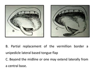 B. Partial replacement of the vermillion border a
unipedicle lateral based tongue flap
C. Beyond the midline or one may extend laterally from
a central base.
 