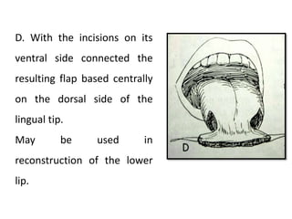D. With the incisions on its
ventral side connected the
resulting flap based centrally
on the dorsal side of the
lingual tip.
May be used in
reconstruction of the lower
lip.
 