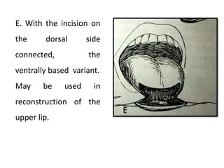 E. With the incision on
the dorsal side
connected, the
ventrally based variant.
May be used in
reconstruction of the
upper lip.
 
