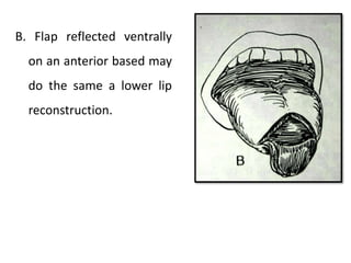 B. Flap reflected ventrally
on an anterior based may
do the same a lower lip
reconstruction.
 
