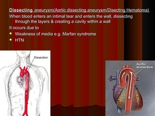 DissectingDissecting aneurysm(Aortic dissecting aneurysm/Disecting Hematoma)aneurysm(Aortic dissecting aneurysm/Disecting Hematoma)
When blood enters an intimal tear and enters the wall, dissectingWhen blood enters an intimal tear and enters the wall, dissecting
through the layers & creating a cavity within a wallthrough the layers & creating a cavity within a wall
It occurs due toIt occurs due to
 Weakness of media e.g. Marfan syndromeWeakness of media e.g. Marfan syndrome
 HTNHTN
99
 