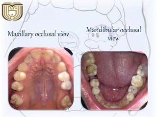 Maxillary occlusal view Mandibular occlusal
view
 