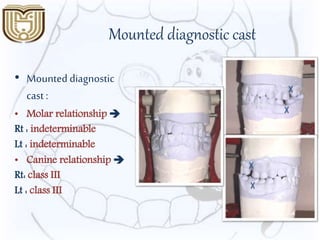 Mounted diagnostic cast
• Mounted diagnostic
cast :
• Molar relationship 
Rt : indeterminable
Lt : indeterminable
• Canine relationship 
Rt: class III
Lt : class III
 