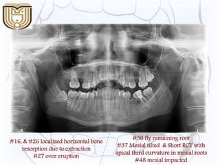 #16, & #26 localized horizontal bone
resorption due to extraction
#27 over eruption
#36 fly remaining root
#37 Mesial tilted & Short RCT with
apical third curvature in mesial roots
#48 mesial impacted
 