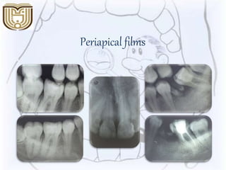 Periapical films
 