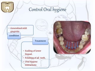 Control Oral hygiene
• Generalized mild
gingivitis
condition
• Scalling of lower
lingual,
• Polishing of all teeth,
• Oral hygiene
instructions
Treatment
 