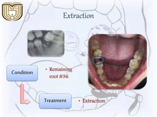 Extraction
Condition • Remaining
root #36
Treatment • Extraction
 
