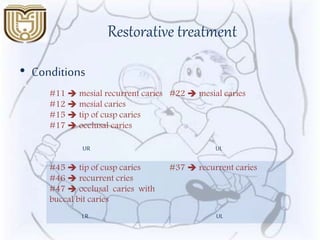 Restorative treatment
• Conditions
#11  mesial recurrent caries
#12  mesial caries
#15  tip of cusp caries
#17  occlusal caries
#22  mesial caries
#45  tip of cusp caries
#46  recurrent cries
#47  occlusal caries with
buccal bit caries
#37  recurrent caries
UR UL
LR UL
 
